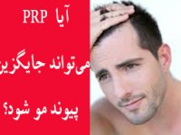 آیا  PRP  می‌تواند جایگزین پیوند مو شود؟