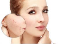 تمام نکات مربوط به جوش از دیدگاه طب سنتی