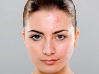 بهترین روش های از بین بردن جای جوش