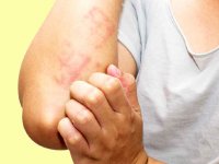 التهابات پوستی و رابطه آن با کووید-۱۹