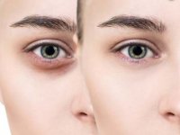 چند راهکار ساده برای رفع سیاهی دور چشم