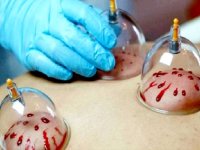 ملاحظات طب سنتی در حجامت