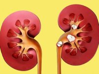 چطور سنگ کلیه نگیریم؟