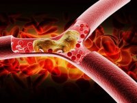 نشانه‌های عجیب از کلسترول بالا که نباید نادیده گرفت