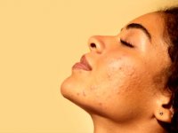 چگونه از پوست چرب مراقبت کنیم؟