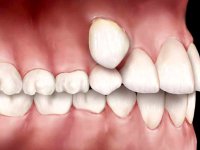 دلایل رویش دندان اضافه فک بالا و پایین
