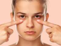 راه های رهایی از حلقه های تیره زیر چشم