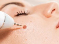 بهترین روش برداشتن خال با لیزر