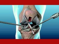 علل و علائم پارگی رباط صلیبی