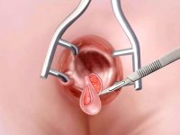 چگونگی انجام جراحی شقاق