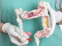 سرطان روده بزرگ، علایم و درمان