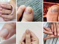 ۷ نشانه هشداردهنده کلسترول بالا که روی ناخن‌ها ظاهر می‌شوند