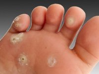 روش‌های خانگی درمان میخچه