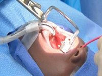جراحی برداشتن لوزه؛ چرا و چه کسانی؟