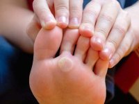 چرا تاول می‌زنیم؟