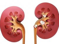 ۳ درمان خانگی برای دفع سنگ کلیه