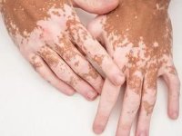 کمبود چه ویتامینی باعث پیسی می‌شود؟