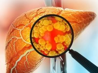 ۵ نشانه روی صورت که خبر از کبد چرب می‌دهند!