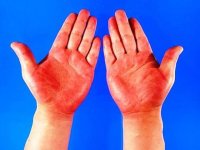 کف دست قرمز نشانه ی چه بیماری است؟
