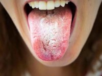 بار زبان چیست و درمان آن چگونه است؟