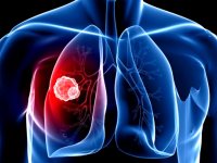 تنگی نفس یکی از مهمترین علائم آمبولی ریه