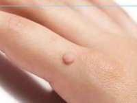 همه چیز درباره زگیل پوستی
