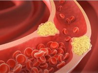 برای کاهش سریع چربی خون چه بخوریم؟