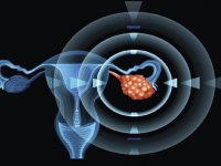 تمرینات هوازی، یاری‌گر بدن زنان در برابر «سندرم تخمدان پلی‌کیستیک»