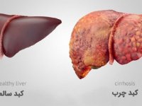 راهکارهای تغذیه‌ای برای درمان کبد چرب + اینفوگرافیک