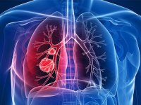 چند توصیه برای مراقبت از ریه ها