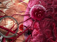 همه چیز پیرامون سرطان خطرناک لنفوم پوستی