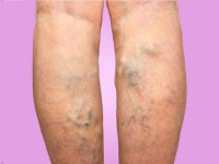 معرفی راهکارهای درمان واریس