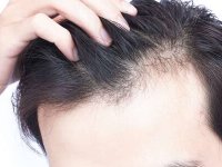 روش‌هایی برای جلوگیری از ریزش موی سر