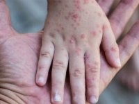 یک مقام وزارت بهداشت: «ما در معرض خطر بالای انتشار بیماری سرخک هستیم»