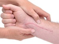 برای از بین بردن جای زخم‌ چه کنیم؟