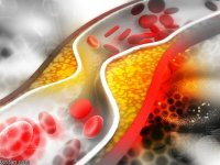 کلسترول بالا در جوانی چه عوارضی دارد؟