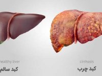 خوراکی‌های مفید و مضر برای کبد را بشناسید