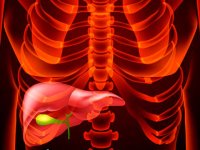 سنگ کیسه صفرا؛ علائم تا درمان