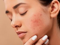 چه غذاهایی باعث بروز آکنه می شوند؟
