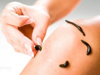 زالو درمانی، روشی کم‌هزینه و مؤثر برای کنترل پسوریازیس