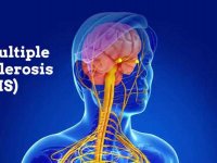 در چه سنی احتمال ابتلا به "ام اس" وجود دارد؟