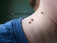 با منگوله‌های پوستی چه کنیم؟(اینفوگرافی)
