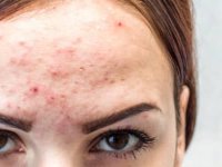 بررسی علت جوش پیشانی و راه‌های خانگی درمان آن