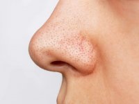 با منافذ باز پوست چه کنیم؟