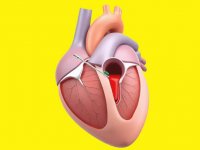 آشنایی با عمل سوراخ قلب و عوارض آن