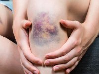 بدن شما هم بی‌دلیل کبود می‌شود؟ پس این مطلب را بخوانید