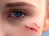 روش های کاربردی برای از بین بردن جای زخم‌