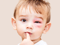 همه چیز درباره شوک آنافیلاکسی