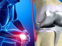 چه موادغذایی بخوریم تا دچار تعویض مفصل زانو نشویم؟