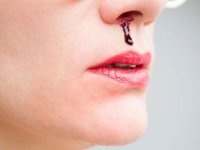 کمبود این ویتامین‌ها باعث خون‌ دماغ می‌شود